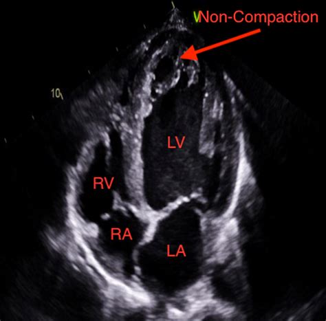 lv non compaction|lv non compaction on echo.